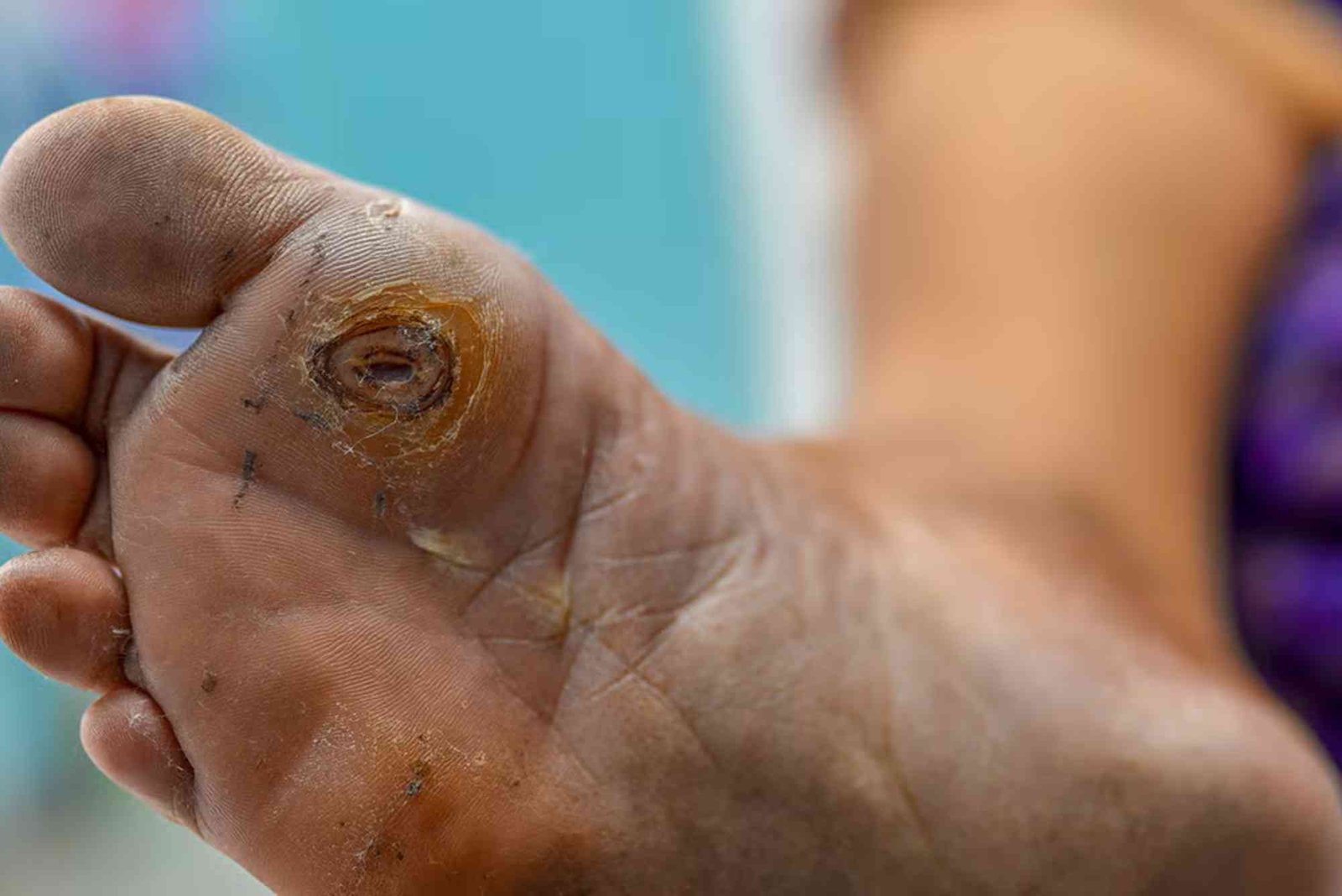 ما هي أعراض ارتفاع الكوليسترول في الجسم؟